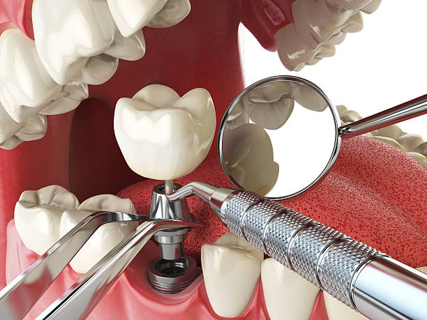 Best Emergency Cosmetic Dentistry (e.g., broken veneers) in Amsterdam, NY